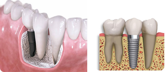 Vanguard Dental Implants